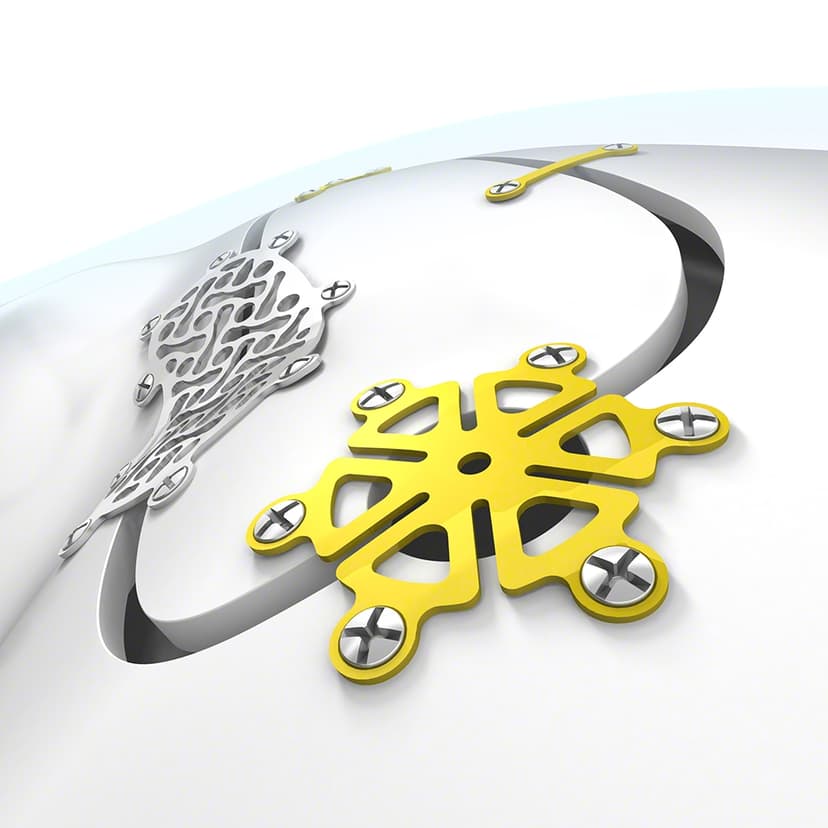 Neuro Platten-Schraubensystem-Produktbild Web Vergrößerung